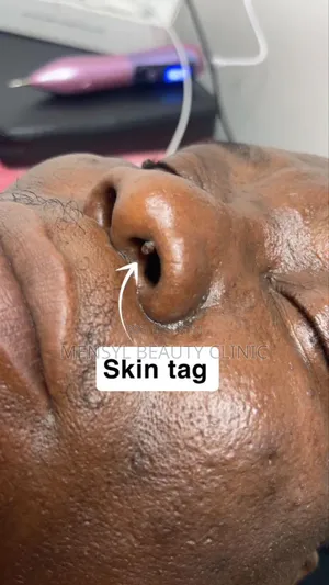 Laser Skin Tag, Warts and Moles Removal