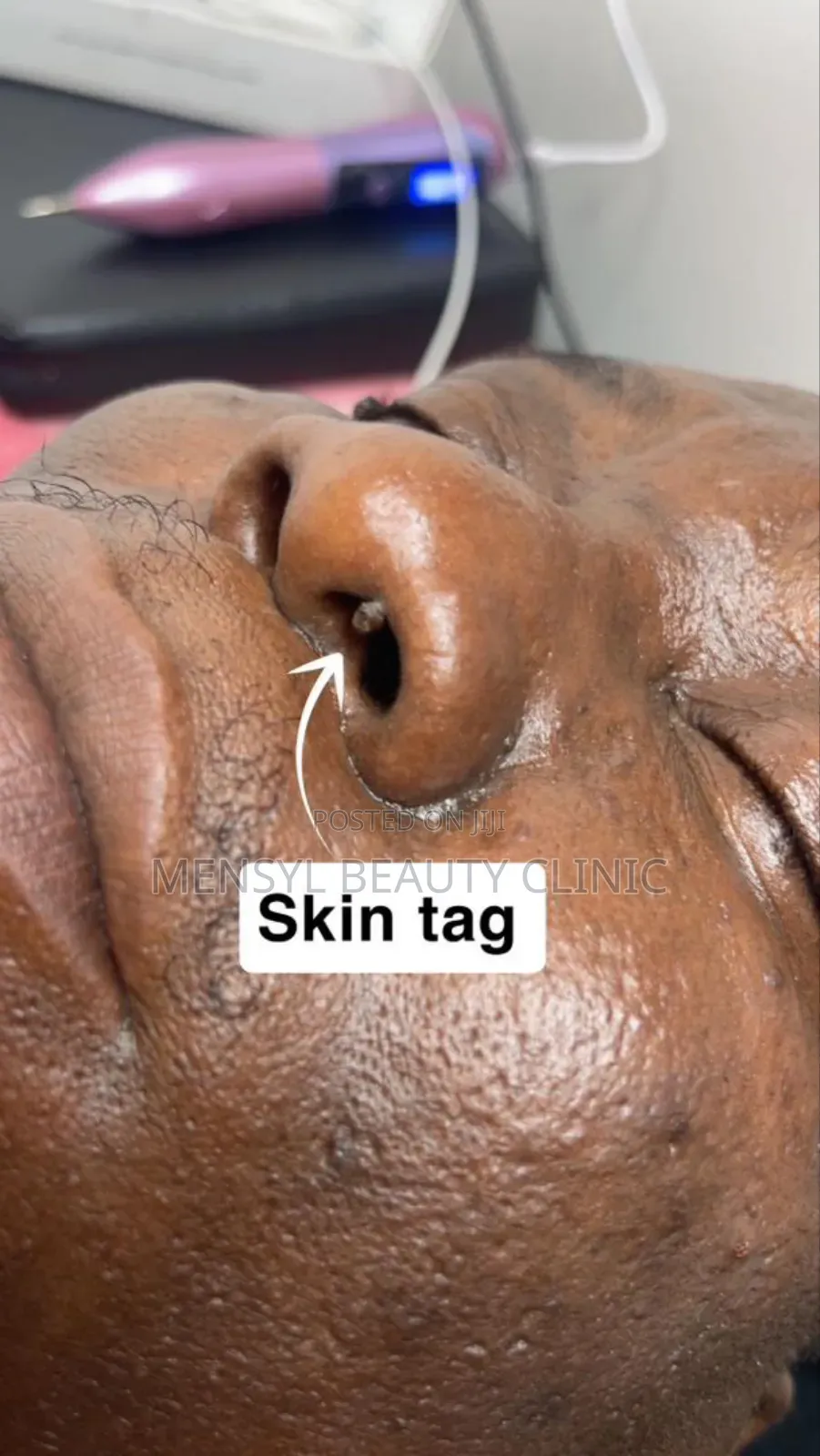Laser Skin Tag, Warts and Moles Removal