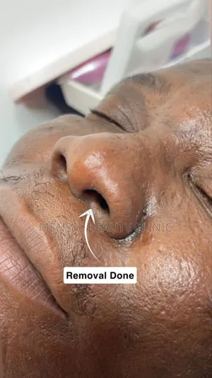 Laser Skin Tag, Warts and Moles Removal