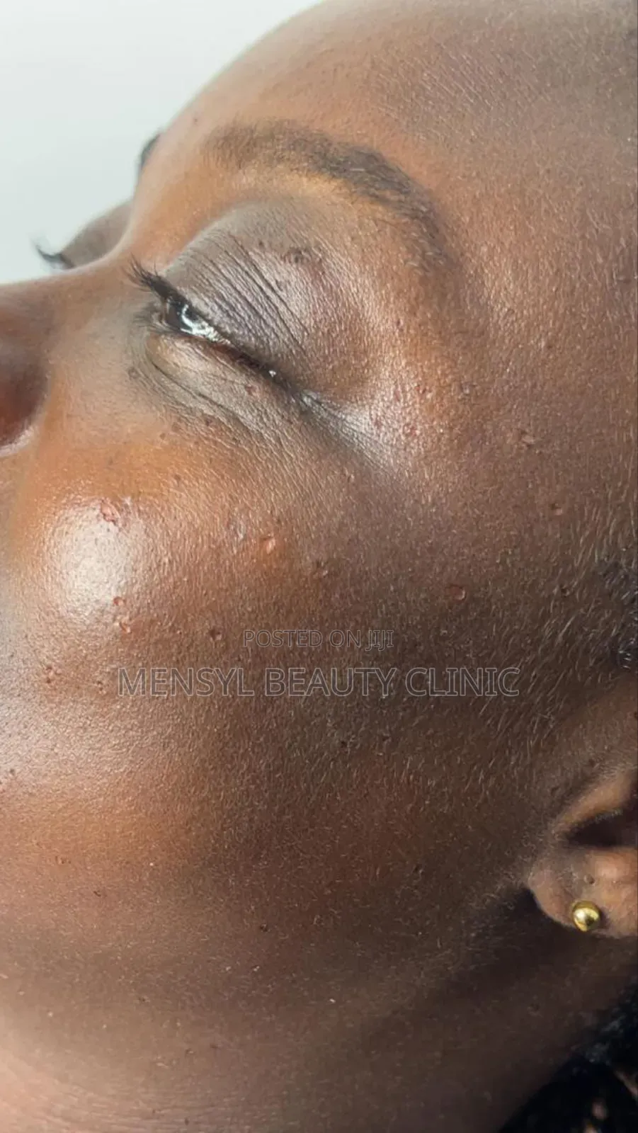 Laser Skin Tag, Warts and Moles Removal