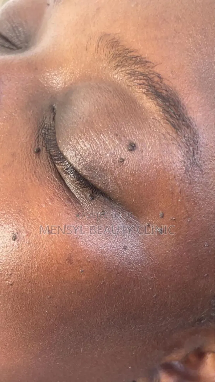 Laser Skin Tag, Warts and Moles Removal