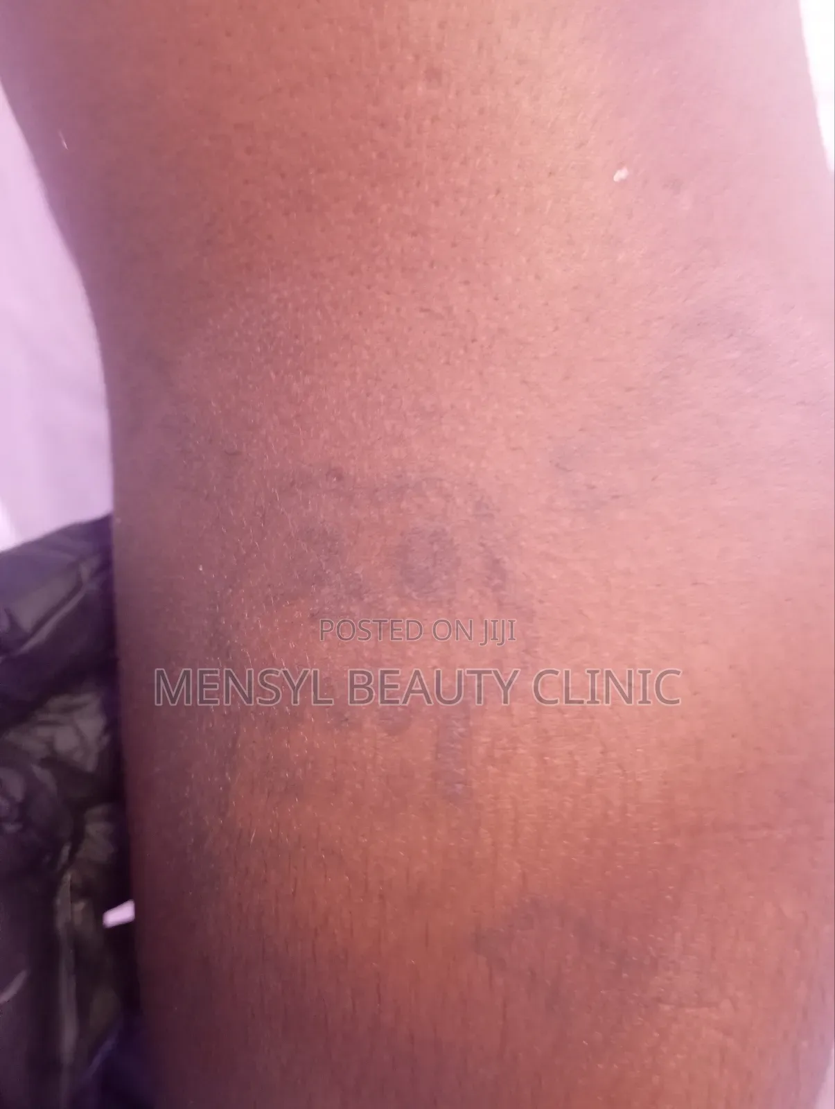 Tattoo Removal