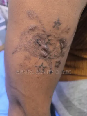 Tattoo Removal