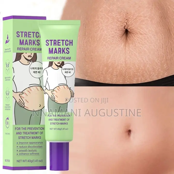 Stretch Marks Removal Cream