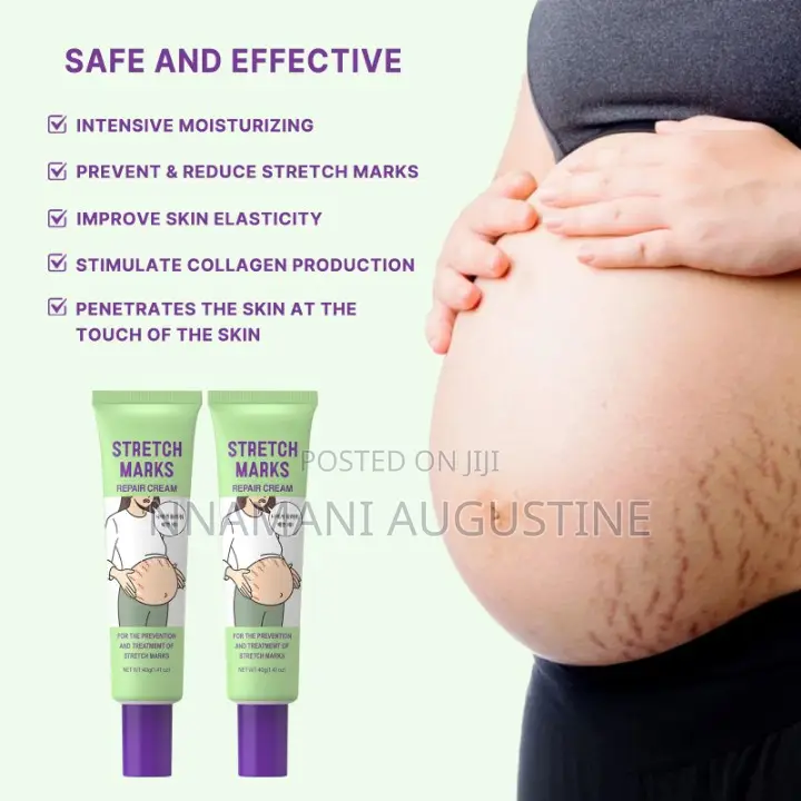 Stretch Marks Removal Cream