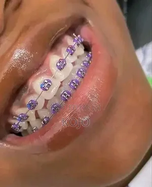 Teeth Braces