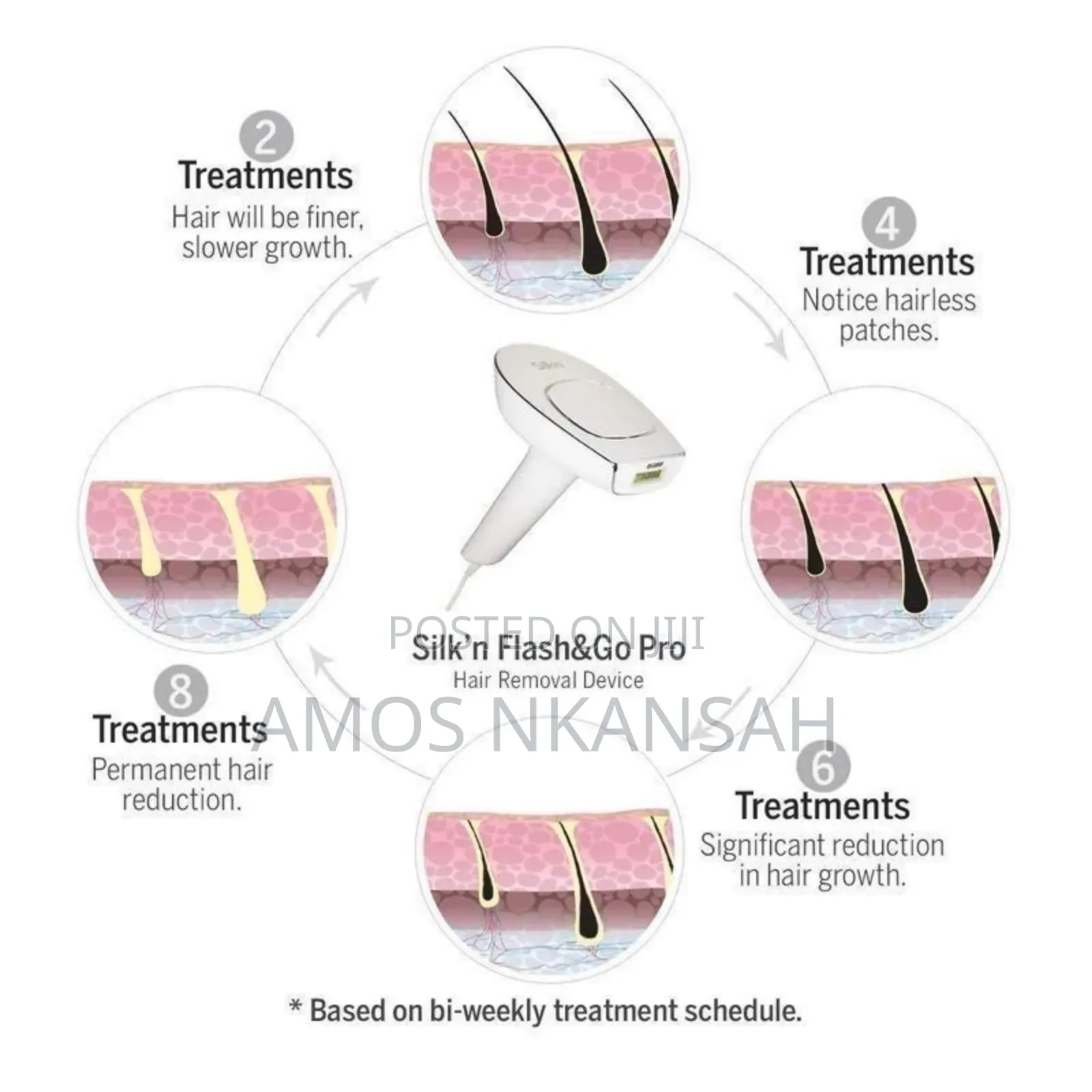 Permanent Flash Hair Removal Device