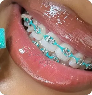 Teeth Braces