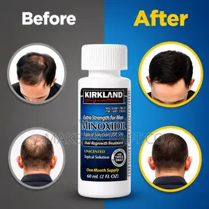 Kirkland Minoxidil for Beard, Hairline and Baldness, Hair Regrowth