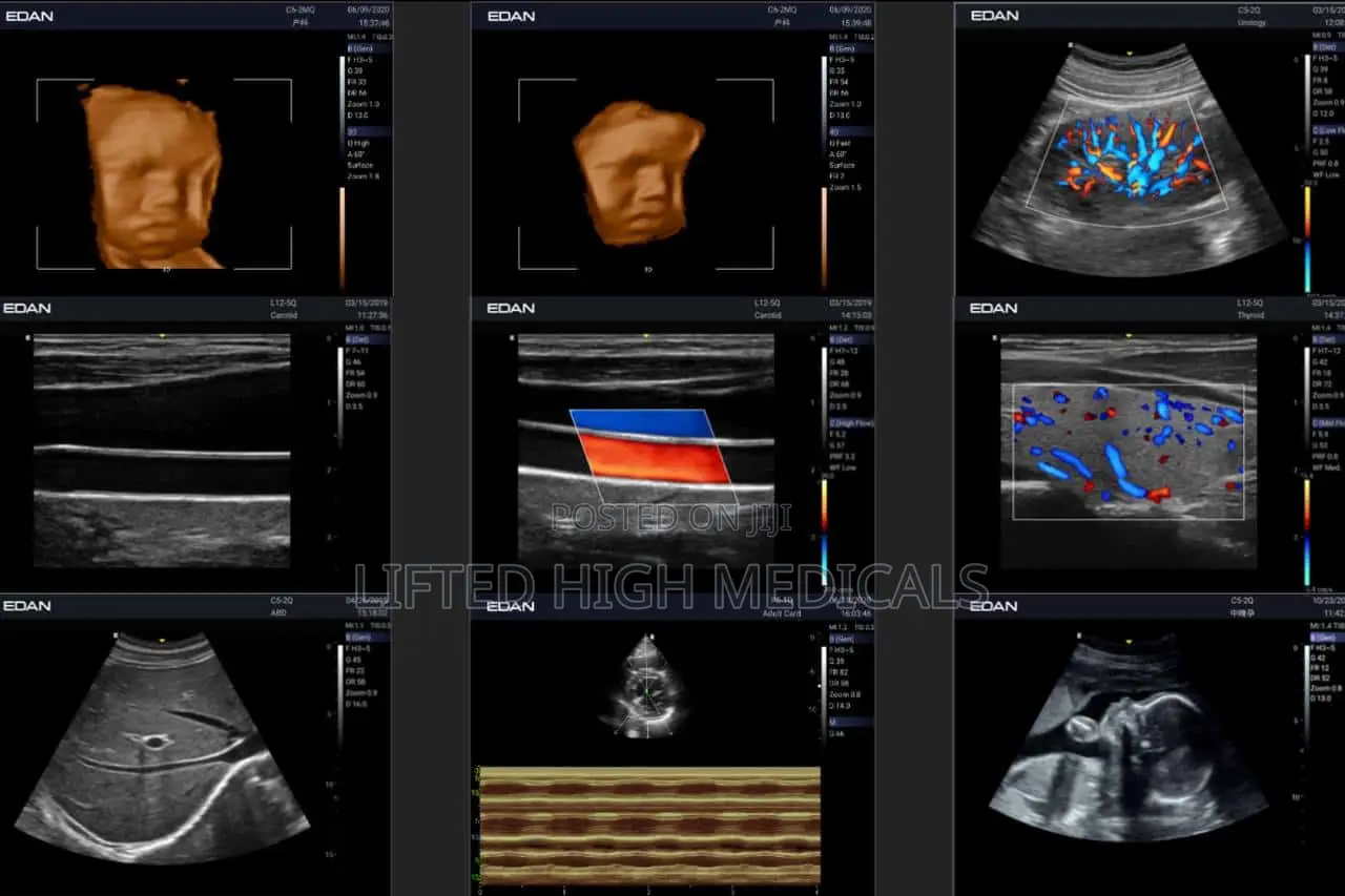 Edan Acclarix Ax3 Portable Color Doppler Ultrasound