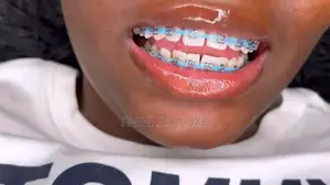 Fashion Tooth Braces