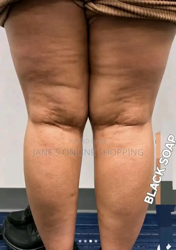 Stretch Marks Removal Soap