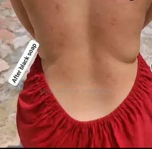 Stretch Marks Removal Soap