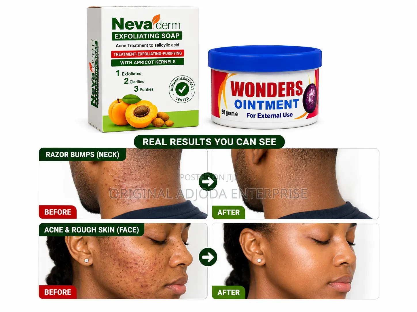 Nevaderm Exfoliating Soap + Wonders Ointment Clear Skin Combo