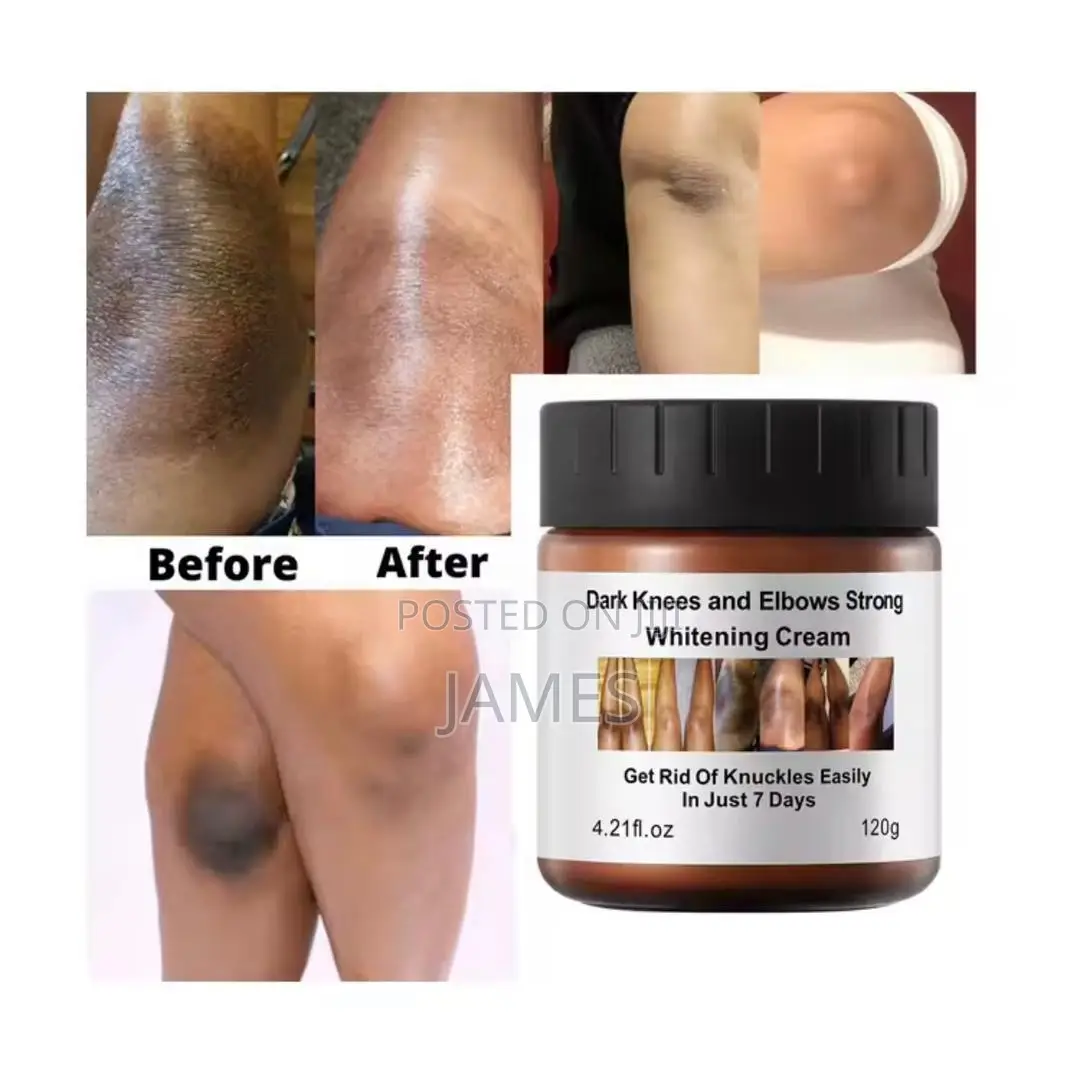 Dark Knees and Elbows Whitening Cream