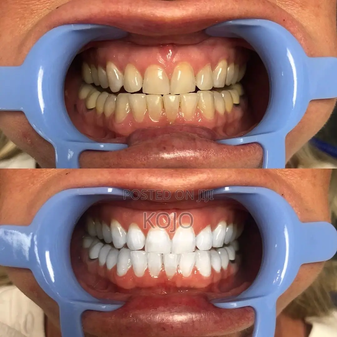 Teeth Whitening