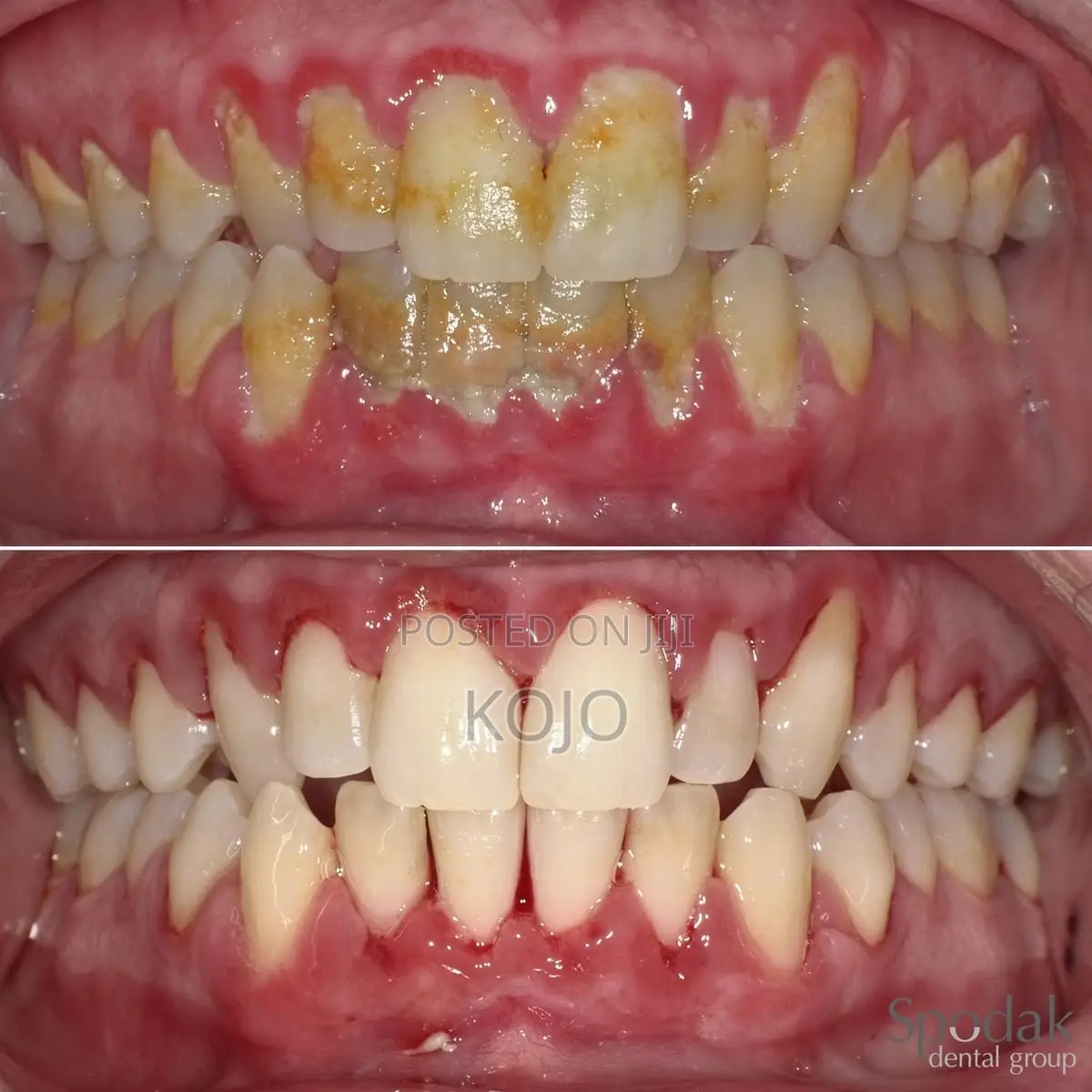 Teeth Cleaning