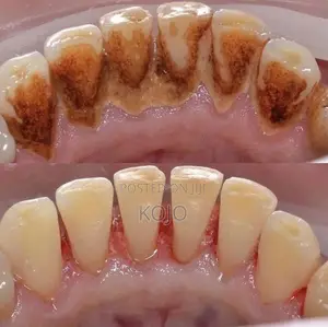 Teeth Cleaning