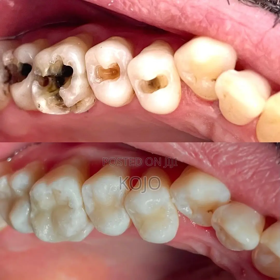 Teeth Cleaning