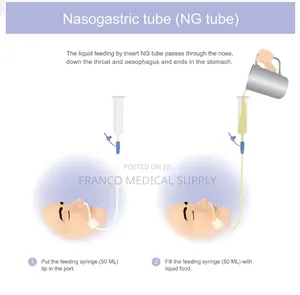 Nasogastric Tube (Ng Feeding Tube )