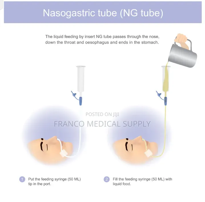 Nasogastric Tube (Ng Feeding Tube )