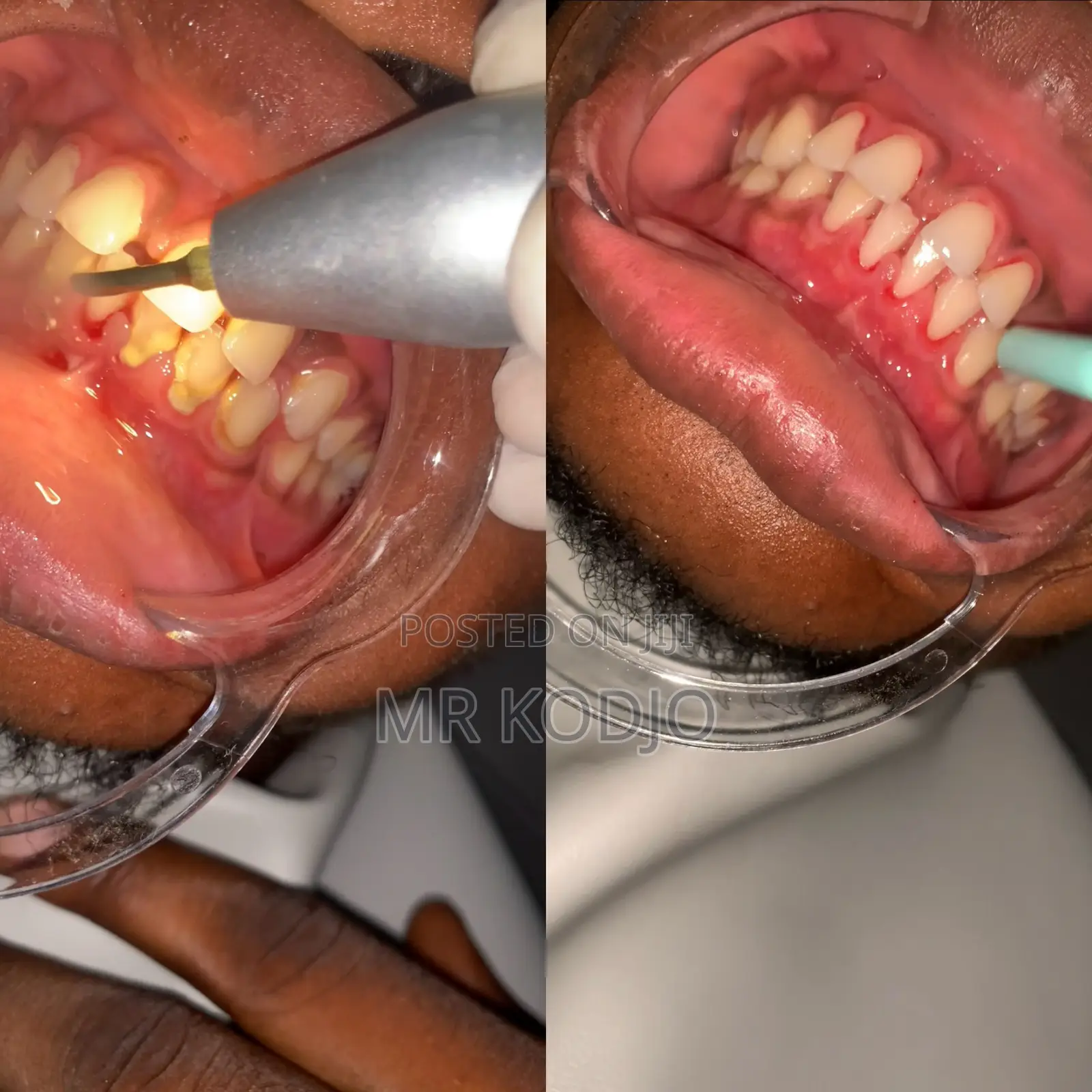 Teeth Cleaning