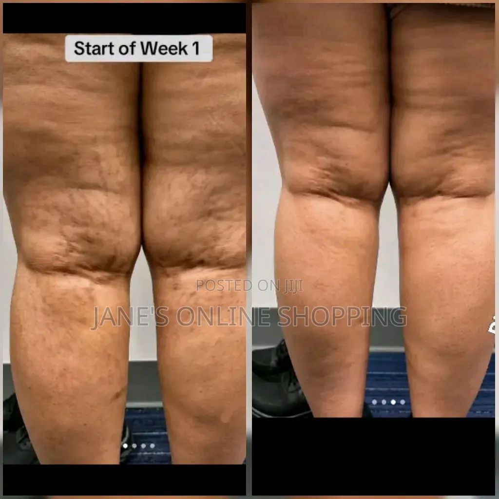 Strechmarks Removal Oil
