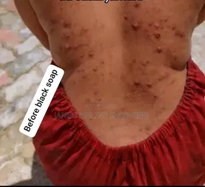 Strechmarks Removal Oil
