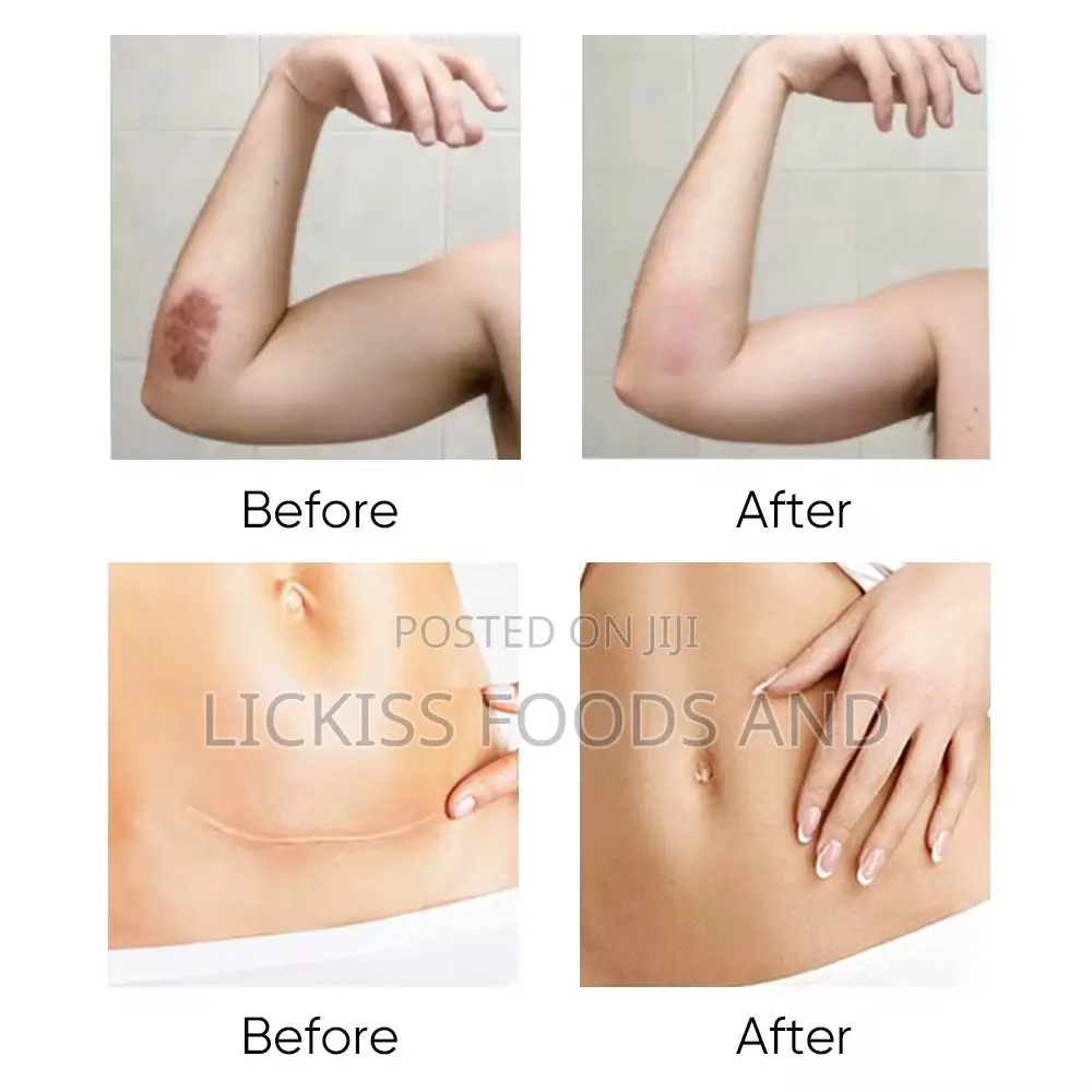 Stretch Marks and Scar Removal Gel