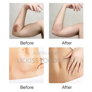 Stretch Marks and Scar Removal Gel