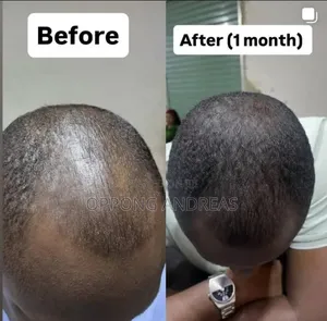 Kirkland Minoxidil 5% Extra Strength Hair Regrowth Solution for Men