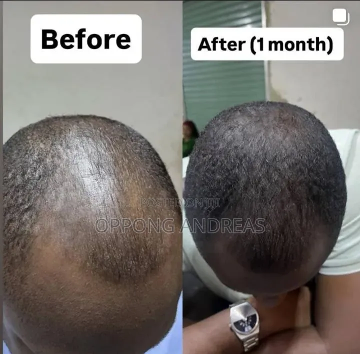 Kirkland Minoxidil 5% Extra Strength Hair Regrowth Solution for Men