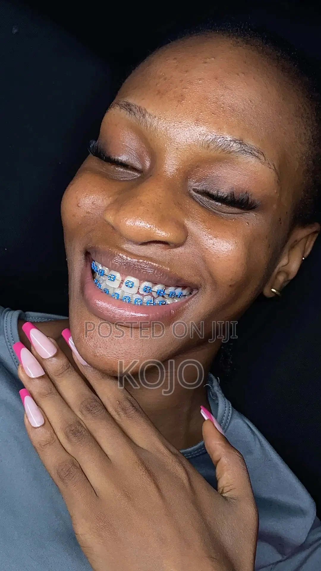 Teeth Braces