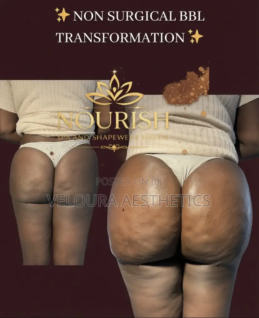 Non-Surgical BBL Fillers | Hip Dip Enhancement | Accra