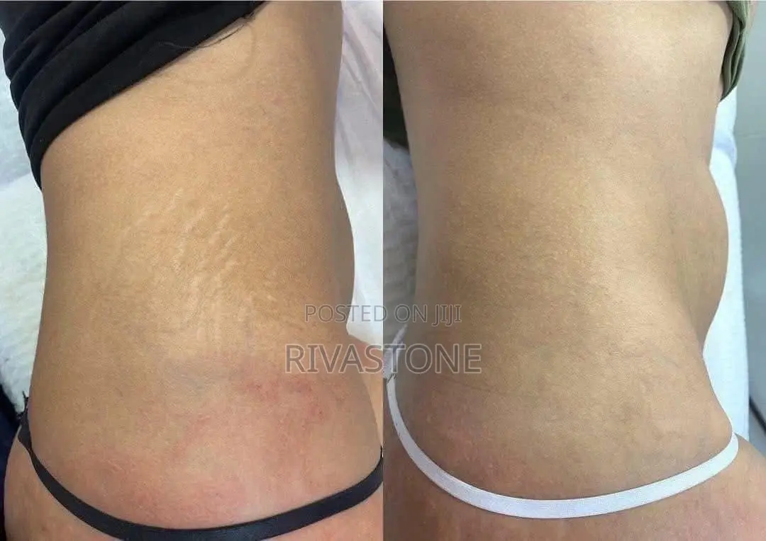 Organic Stretch Marks Removal Cream