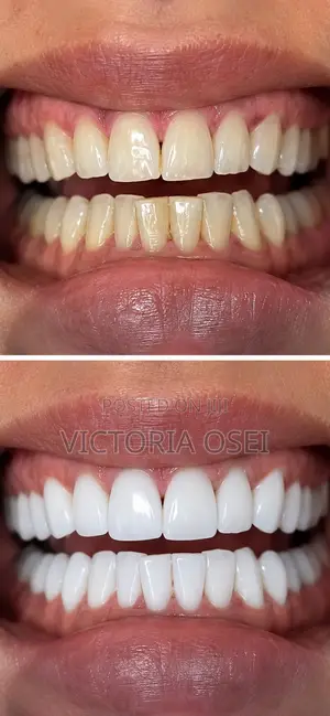 Prominent Teeth Whitening