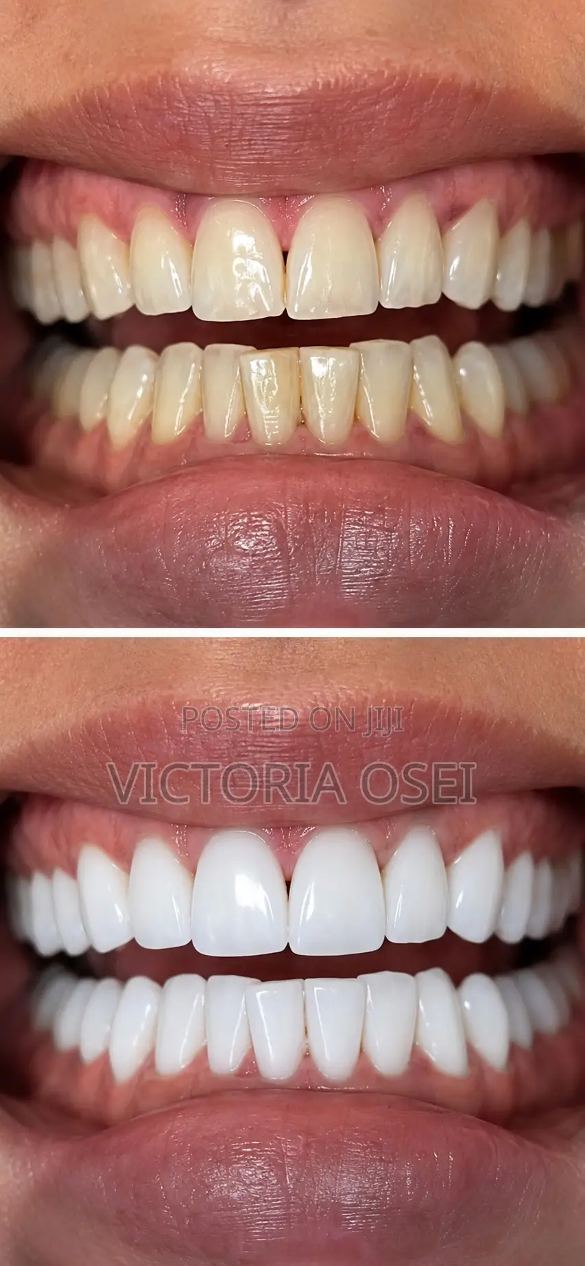 Prominent Teeth Whitening