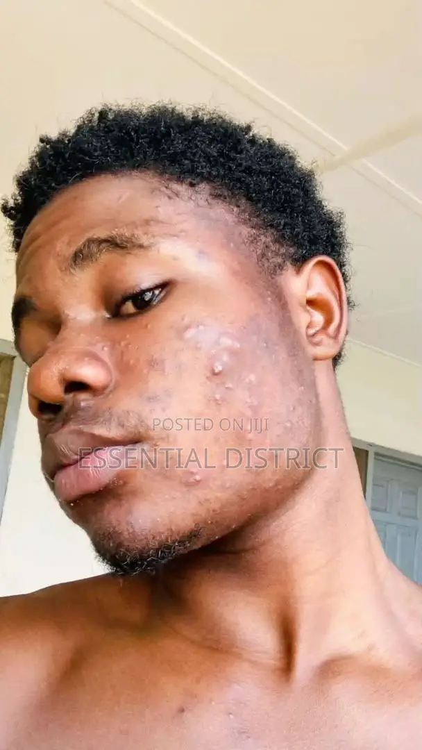 Blackhead Control Facial Scrub 