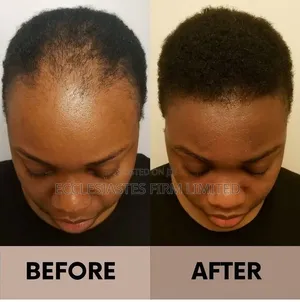 Hair Growth Oil and Cream