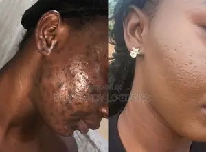 Acne Face Cream