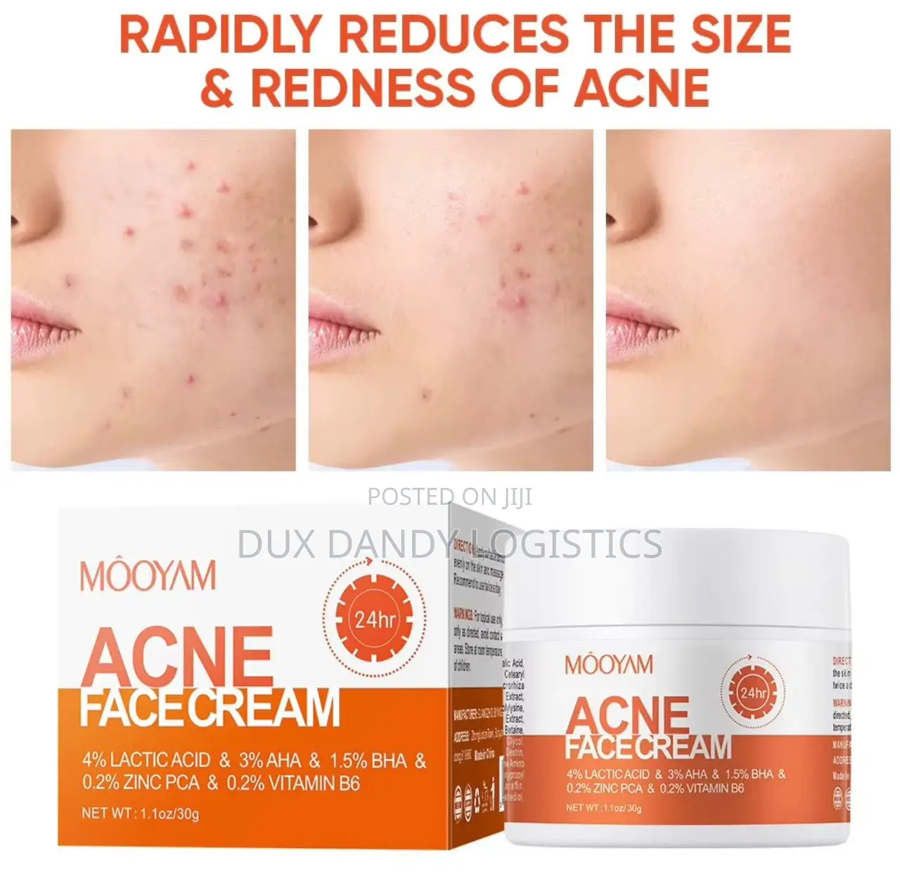 Acne Face Cream