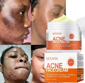 Acne Face Cream