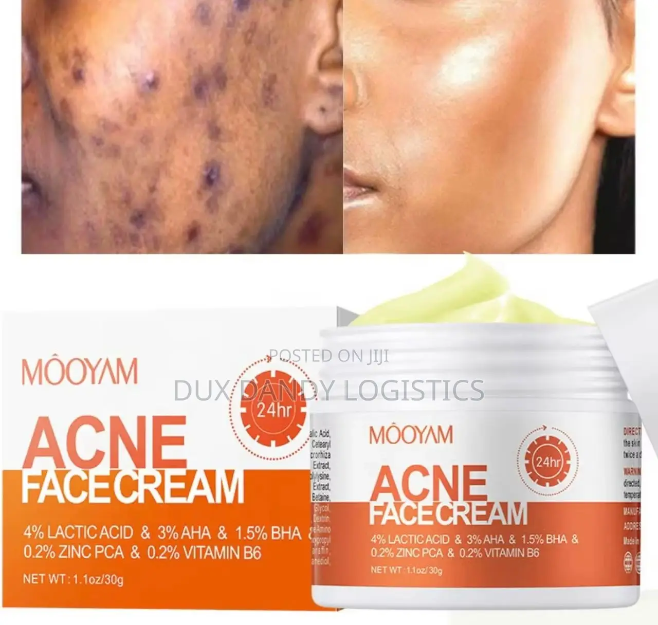 Acne Face Cream
