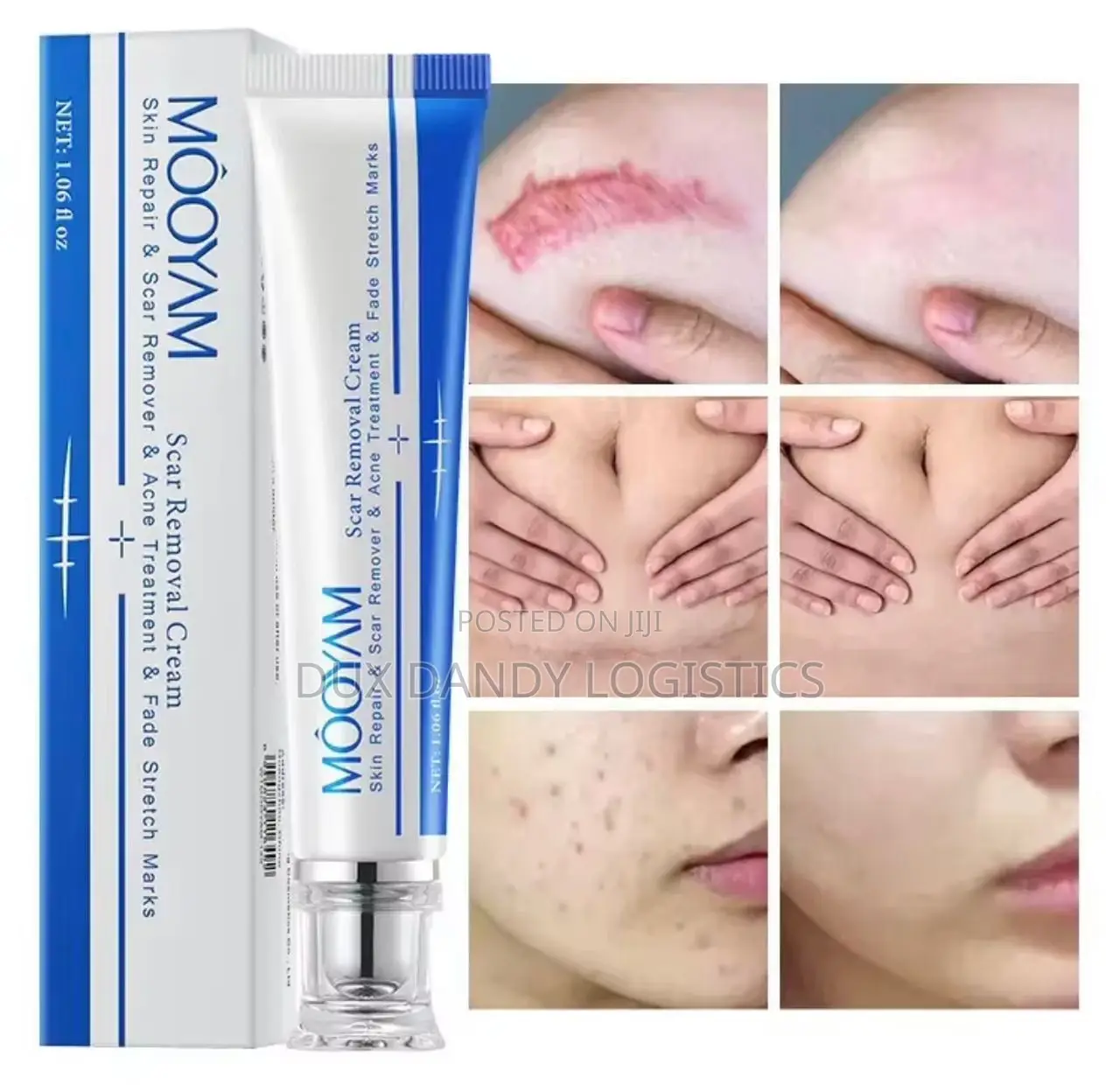 Scar, Stretch Mark, Acne Removal Cream