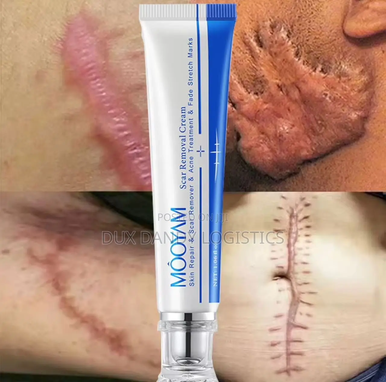 Scar, Stretch Mark, Acne Removal Cream