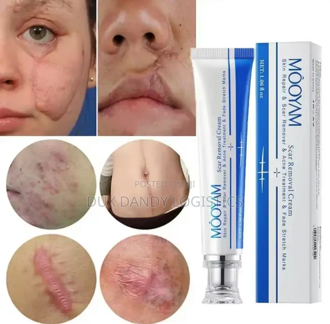 Scar, Stretch Mark, Acne Removal Cream