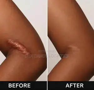 Advanced Scar Gel
