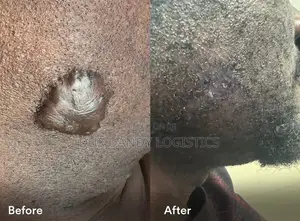 Advanced Scar Gel
