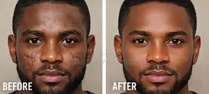 Advanced Scar Gel