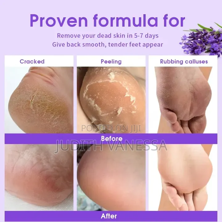 Foot Peel,Exfoliating Foot Mask